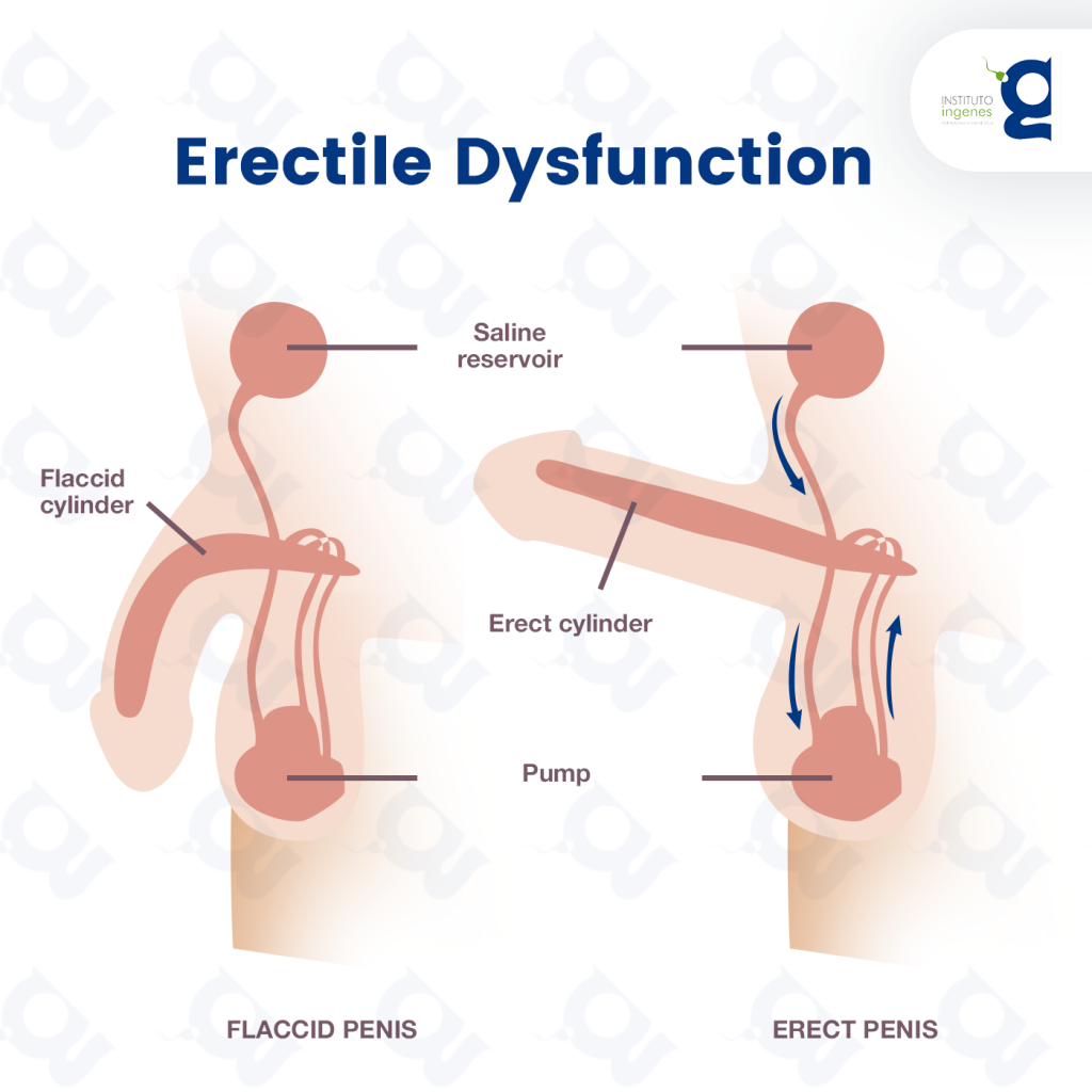 Erectile dysfunction (ED) is often a symptom of another health problem.